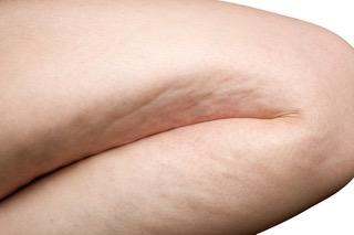 cellulite removal